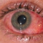 eye